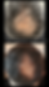This image shows a client after 3 PRP hair treatments 12 weeks apart.