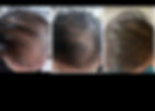PRP Exosome hairloss treatments
