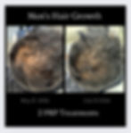 PRP Hair Restoration for Men