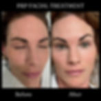 PRP facial treatment before and after at Elev8 Medical Aesthetics in Kitchener-Waterloo