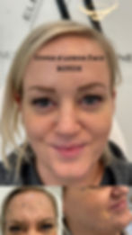Before and after Botox treatment in Kitchener-Waterloo by Rinku