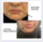 This image contains two pictures. The top is the before lip filler picture. And bottom of this is an after lip filler procedure.