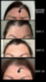This graphic shows 4 pictures of the same person after getting botox. The results are before, on day 1, on day 5 and on day 16. Botox forehead results