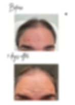 This image shows the before and after picture of a clients forehead 5 days after getting botox treatement