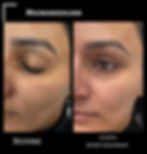Before and after pictures of one microneedling treatment for the face