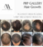 "Before and after PRP hair loss treatment results in Waterloo region"