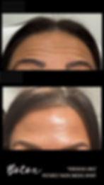 Best botox before and after in Kitchener Waterloo