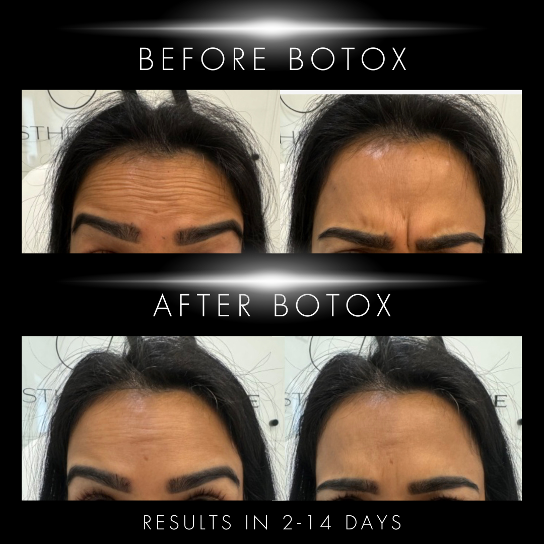 Wrinkle relaxer treatment at Elev8 Aesthetic Medicine