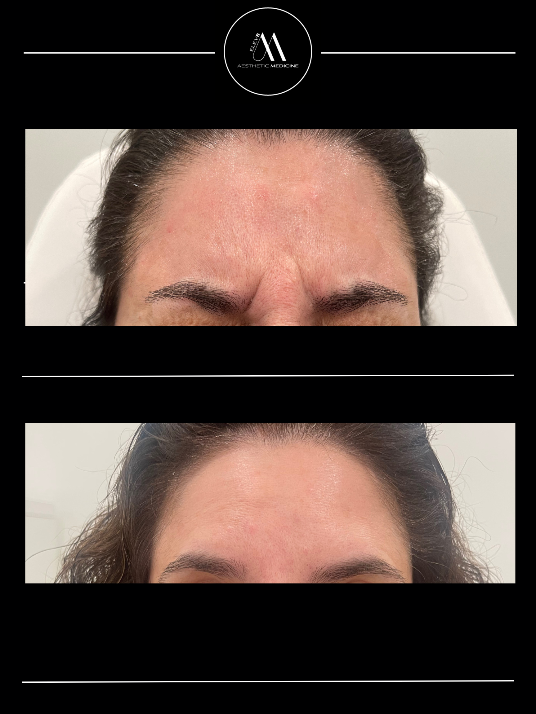 This image shows the before and after pictures of a client who received botox treatment in their forehead.