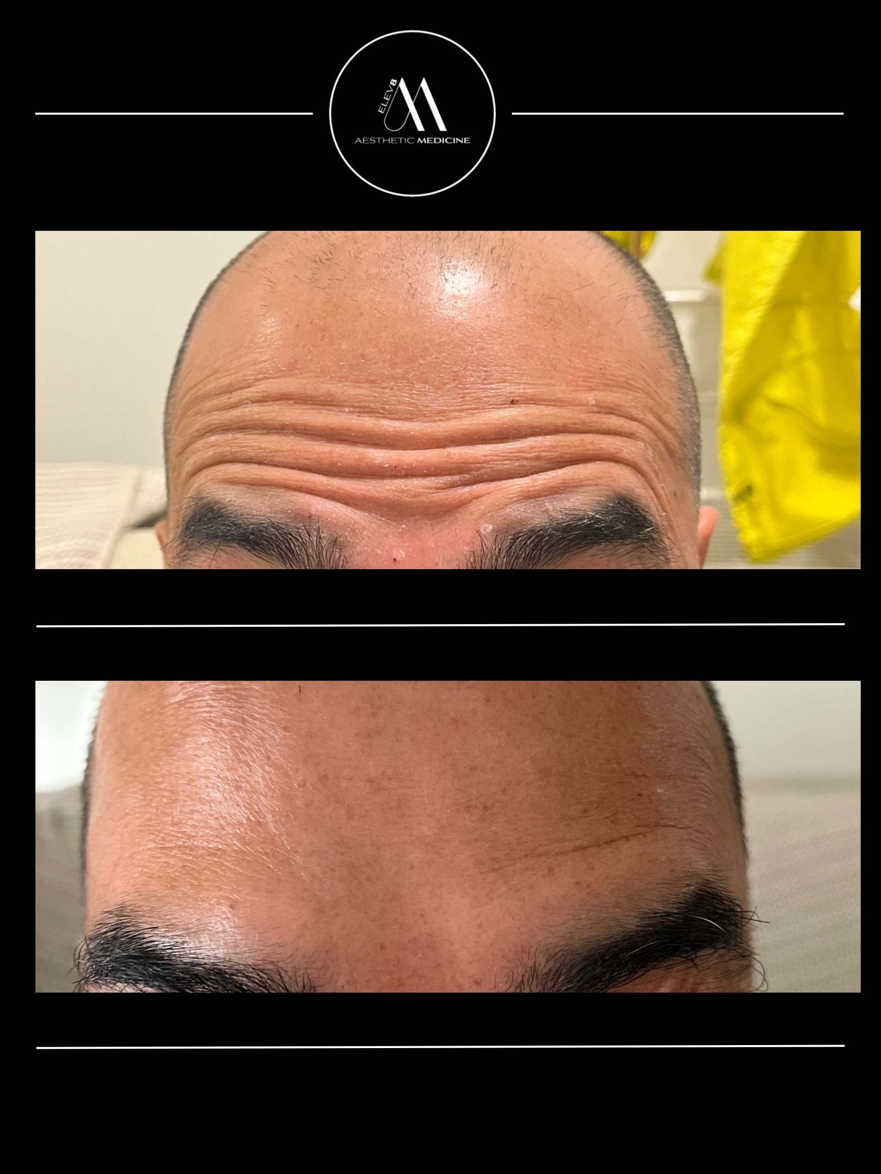 This image shows the before and after pictures of a client who received botox treatment in their forehead.