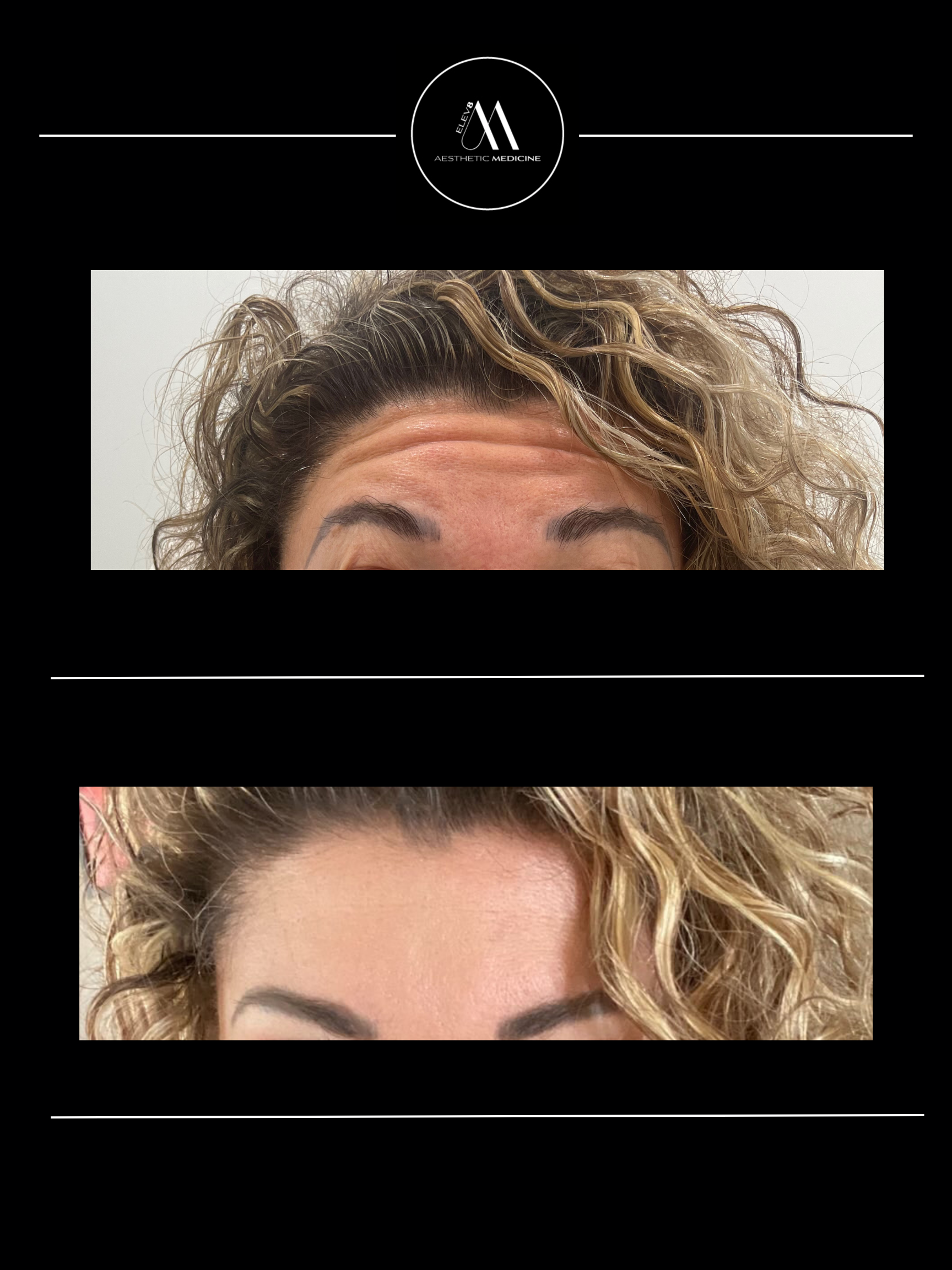 This image shows the before and after pictures of a client who received botox treatment in their forehead.