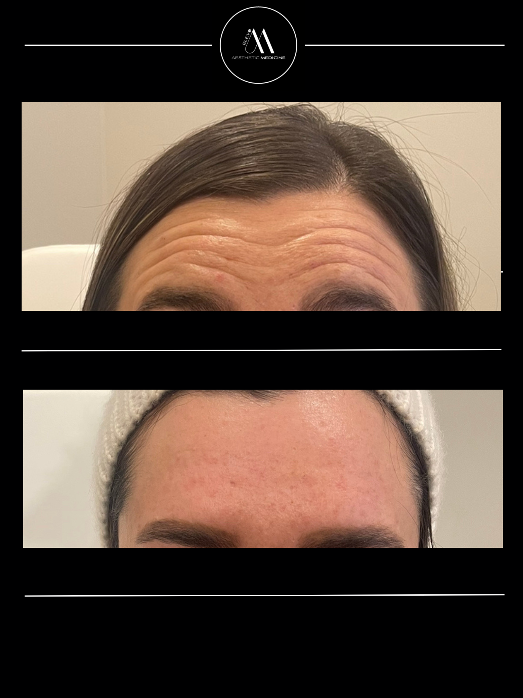 This image shows the before and after pictures of a client who received botox treatment in their forehead.