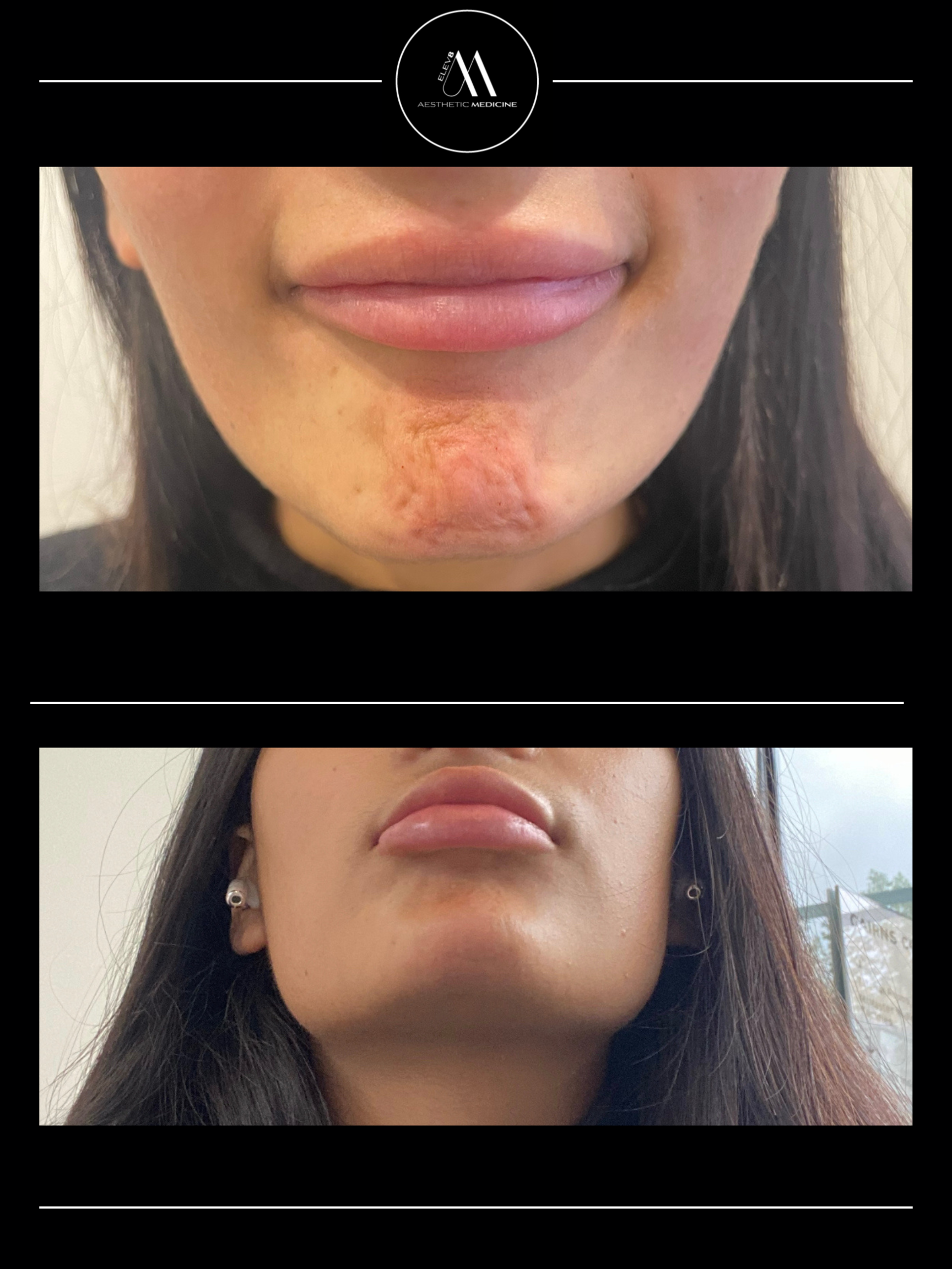This image shows the before and after pictures of a client who received lip filler treatment