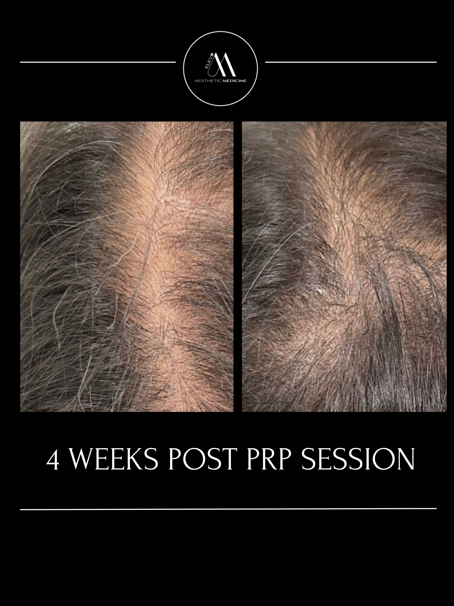 This image shows the before and after of a client who has undergone PRP hair treatments.