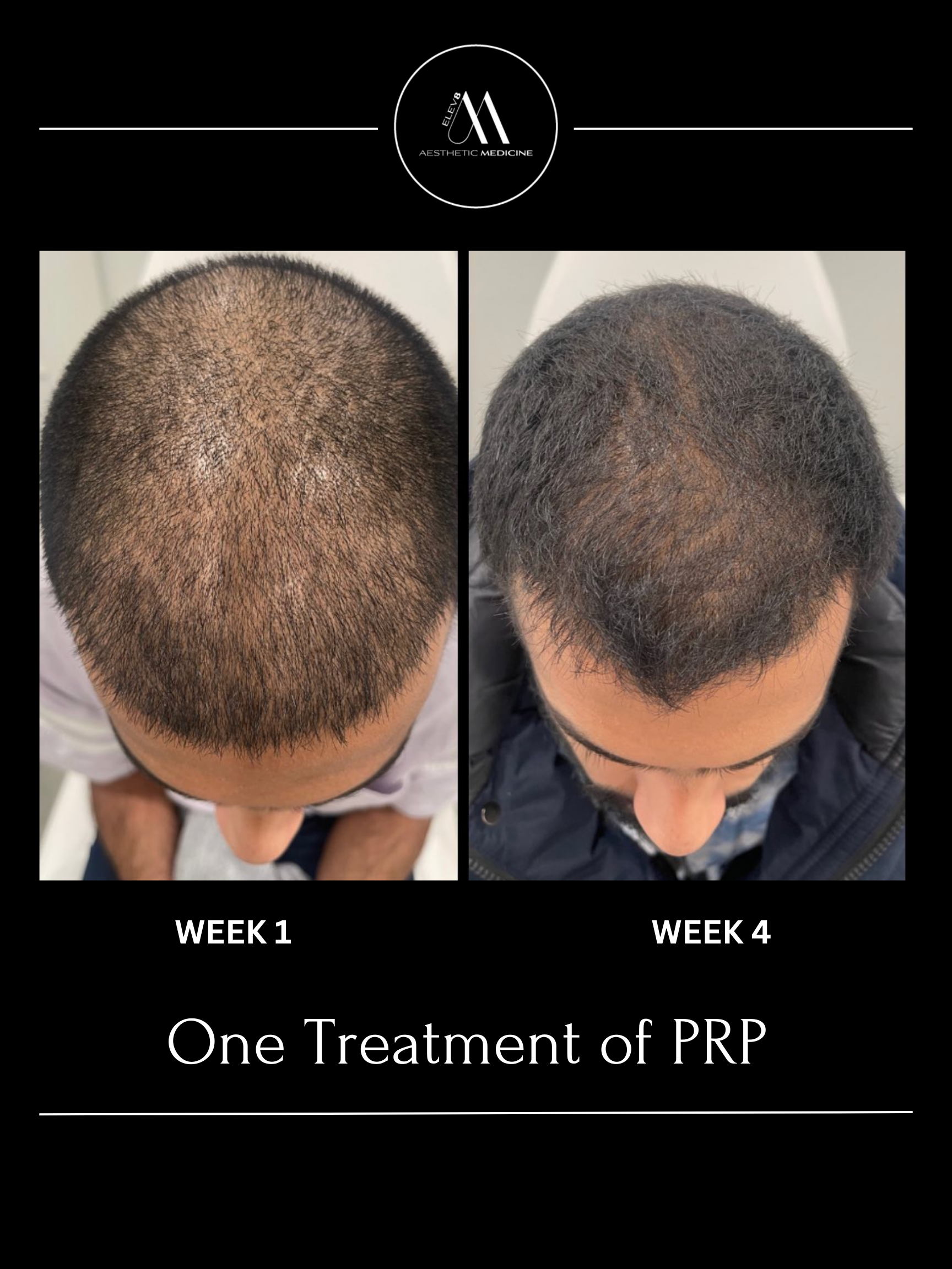 This image shows the before and after of a client who has undergone PRP hair treatments.
