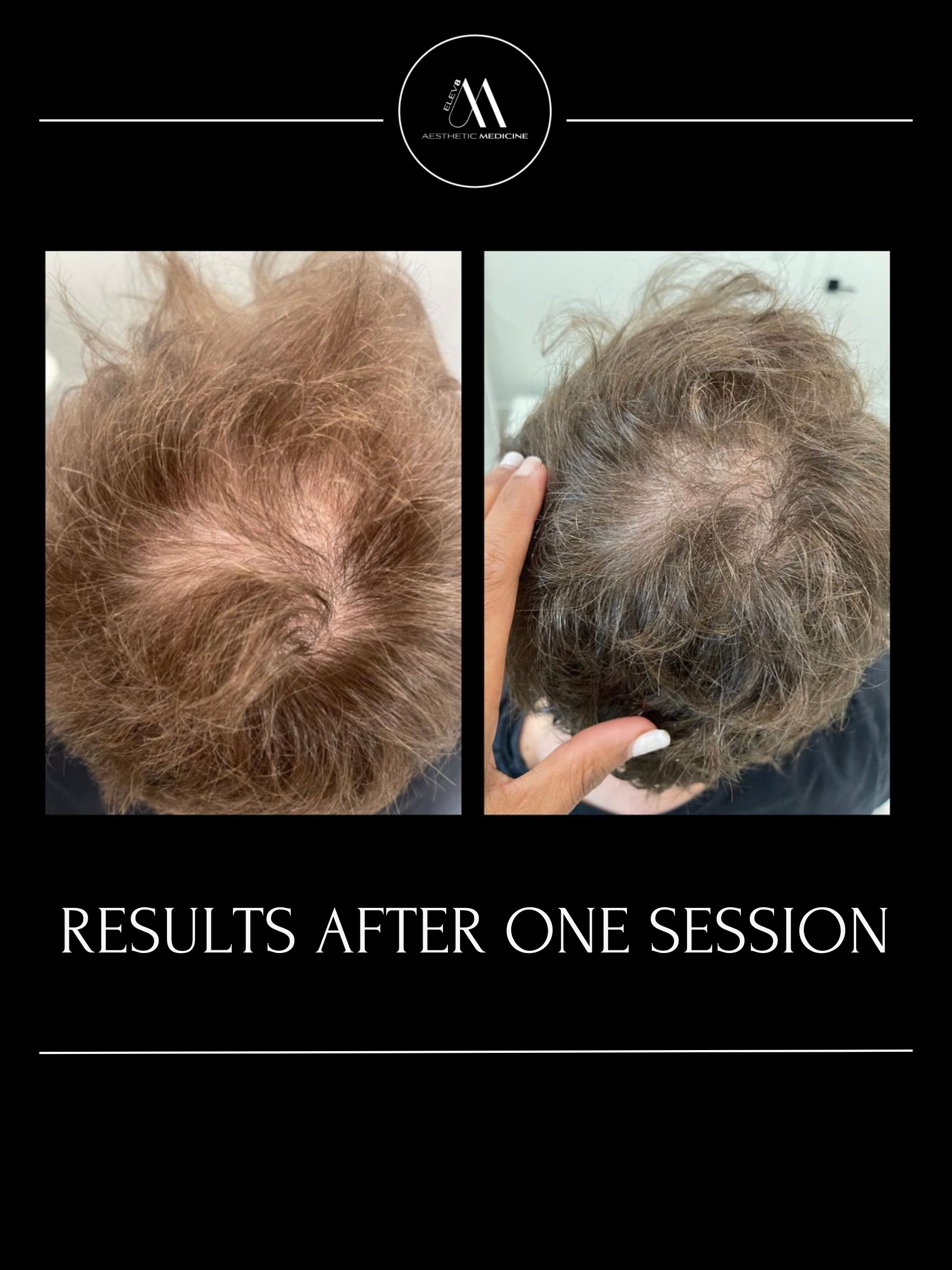 This image shows the before and after of a client who has undergone PRP hair treatments.