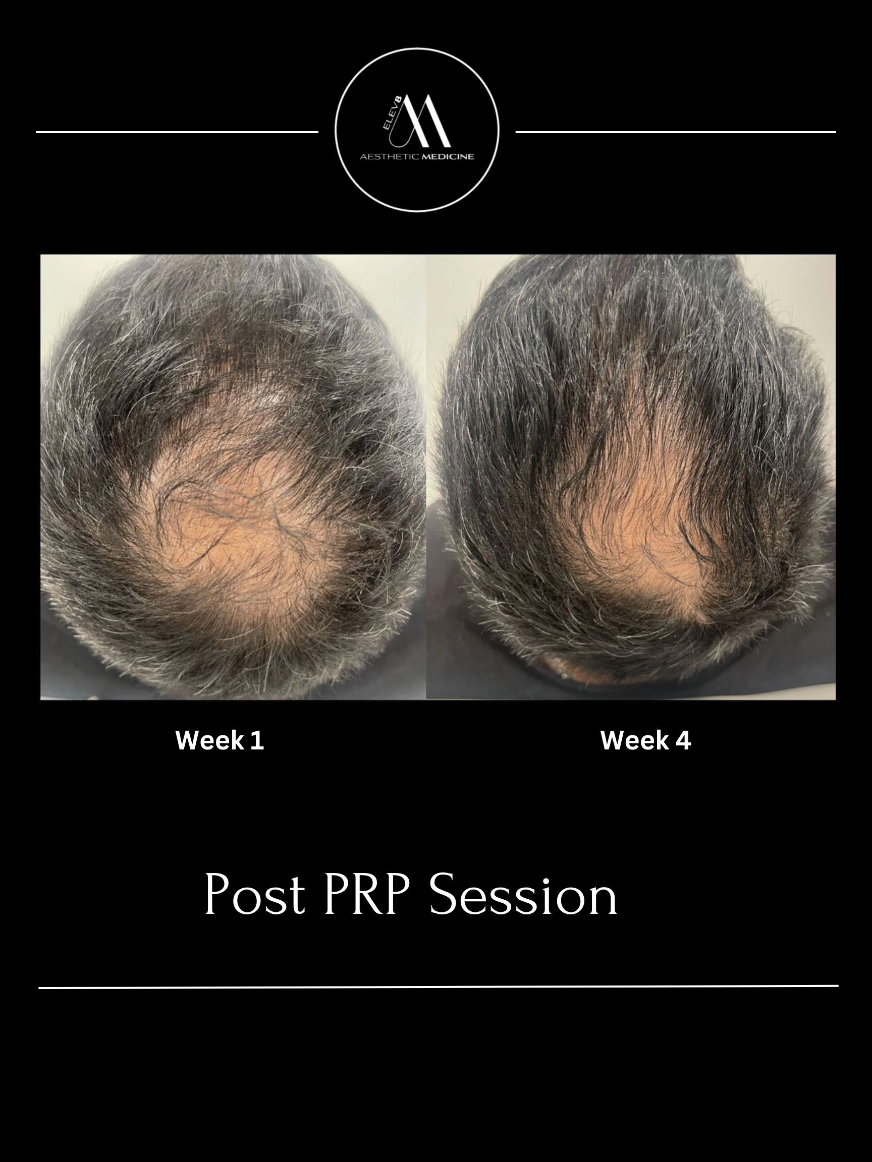 This image shows the before and after of a client who has undergone PRP hair treatments.
