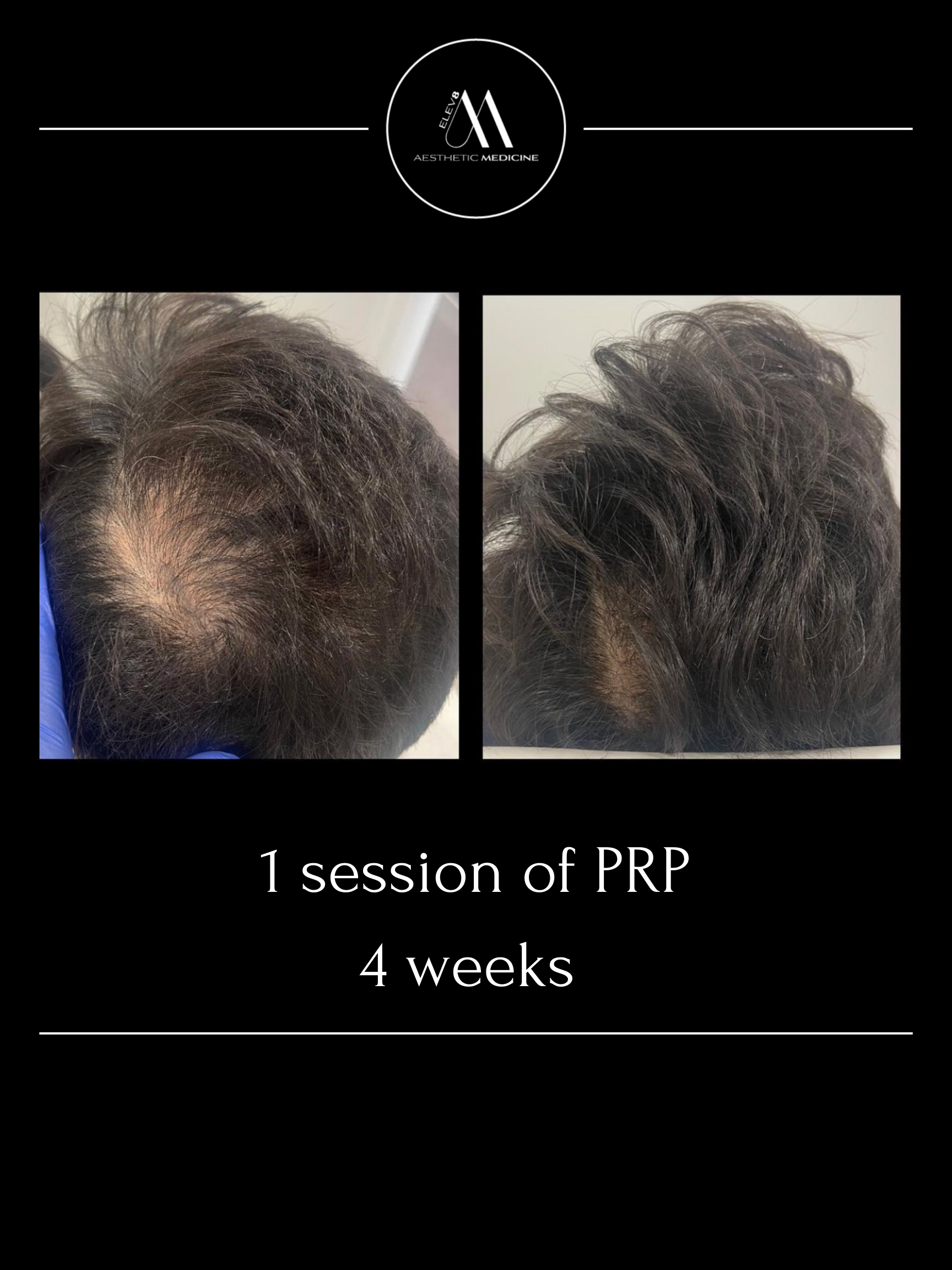 This image shows the before and after of a client who has undergone PRP hair treatments.