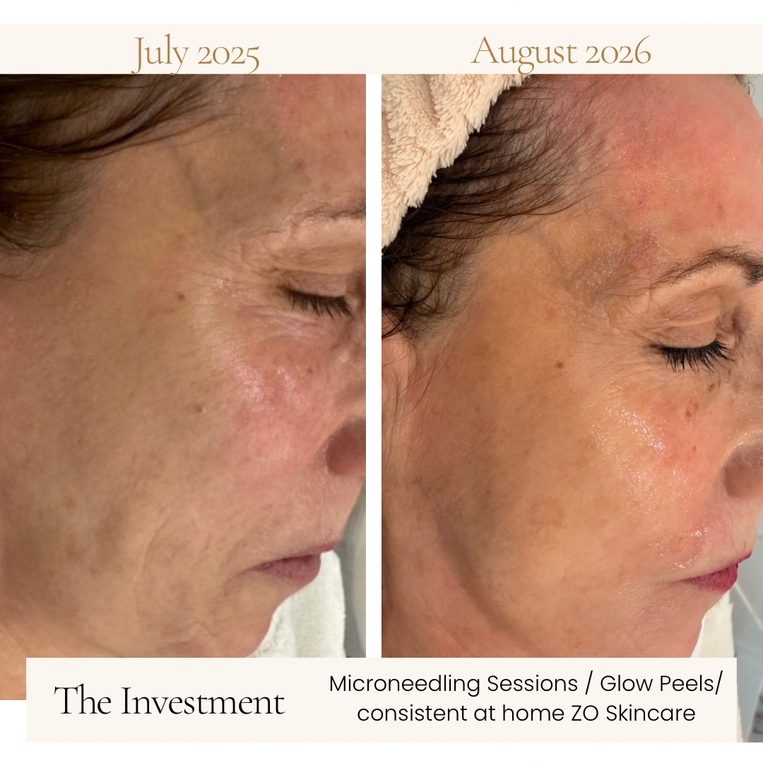 Hair rejuvenation treatment at Elev8 Aesthetic Medicine